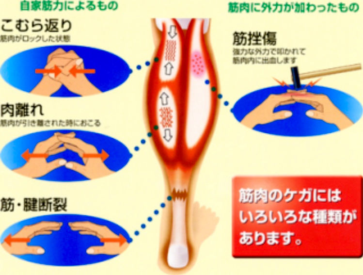 筋損傷の種類