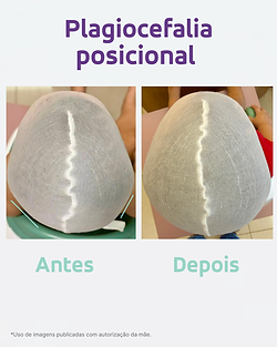 Resultado Tratamento capacetinho