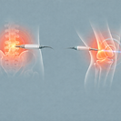 Dibujo de radiofrecuencia térmica y pulsada