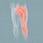 Dibujo de dolor de ciática