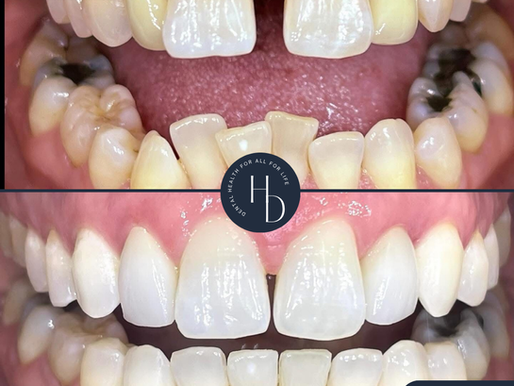Invisalign Open Event June 2026 – Start Your Smile Transformation for £3,999