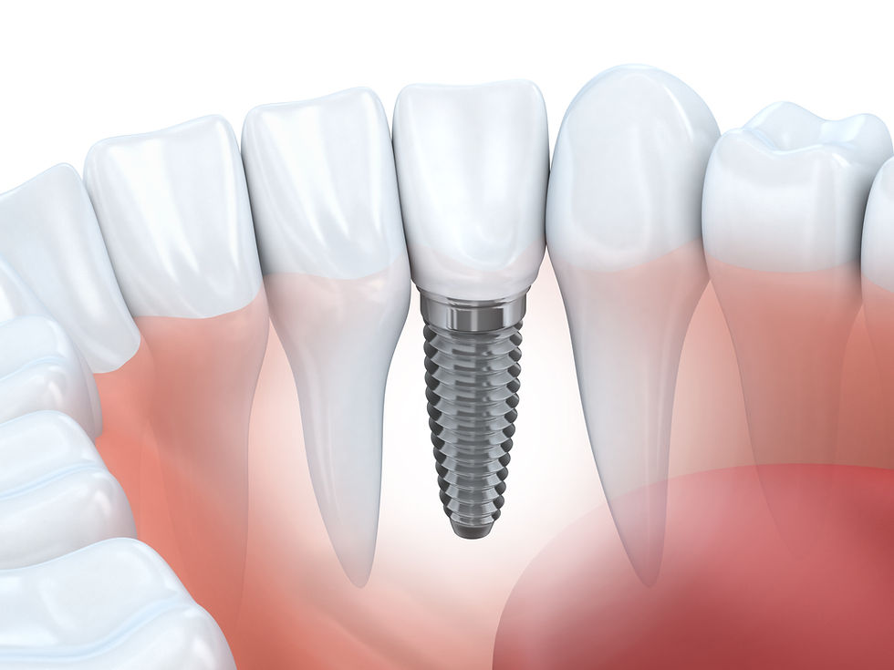 Recreation of a dental implant next to natural teeth, allowing patients to visual what the dental implant procedure looks like when finished