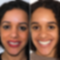 Internal Whitening.png