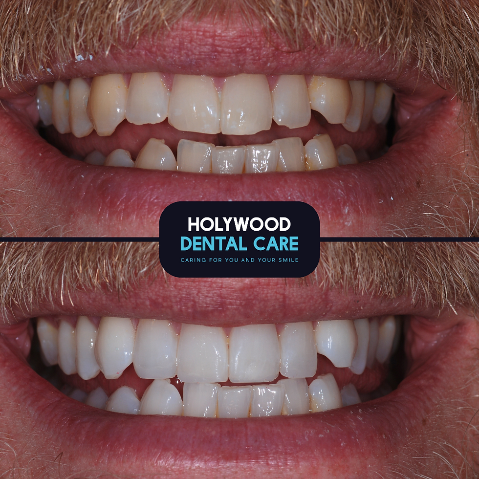 Does Teeth Whitening Work?