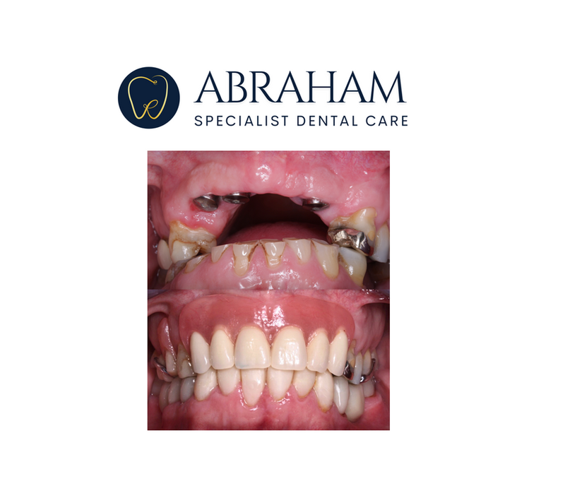 Clinical Case 5: Diastema midline space closure with composite