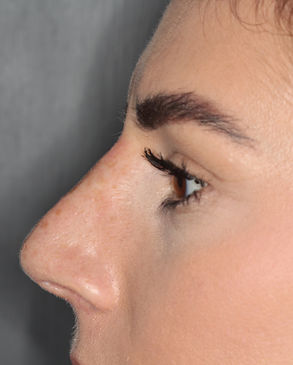 nose DF after.jpeg