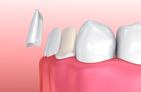 Veneers Manchester