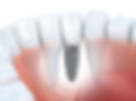 Dental Implants Manchester