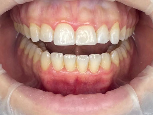 Gum Disease Treatment in Canada Water: Why SpecialistCare Makes the Difference