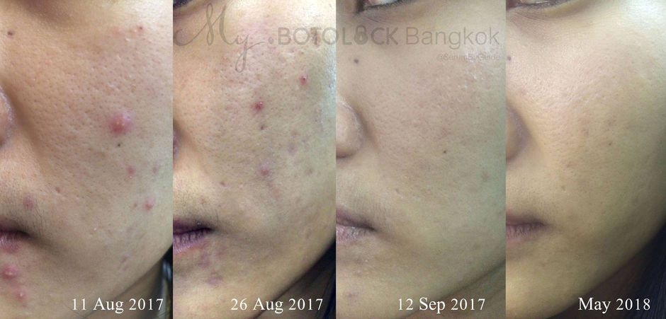 รีวิวสิว ผิวไม่เนียน By MY ACT