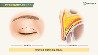 BAE_상안검눈매교정_Ani (0-00-34-15).png