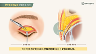 BAE_상안검눈매교정_Ani (0-00-13-00).png