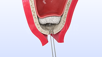 SureOssFiber (0-00-46-28).png