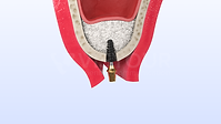 SureOssFiber (0-01-00-01).png