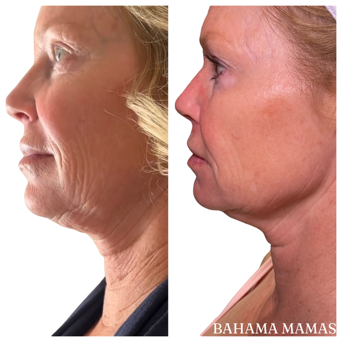 Before and after result of Jet Plasma treatments in Pismo Beach