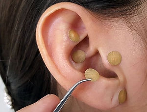 auriculoterapia-obesidad-sobrepeso-500x3