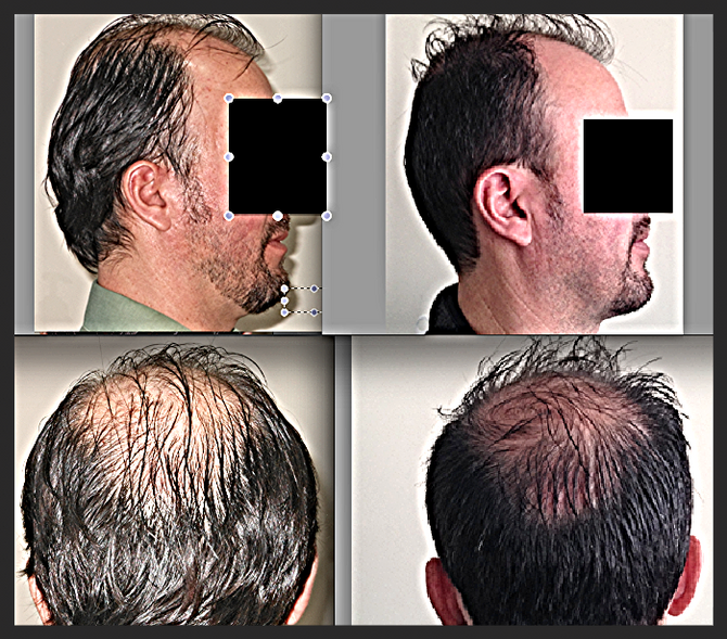 ¿SE PUEDE PREVENIR LA CAÍDA DEL CABELLO?
