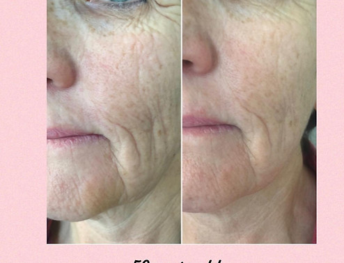 Procell Treatment 2.jpeg