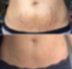 Stretchmark Revision Apprenticeship