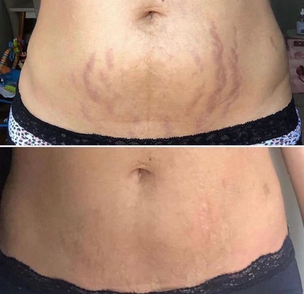 Stretchmark Revision Apprenticeship