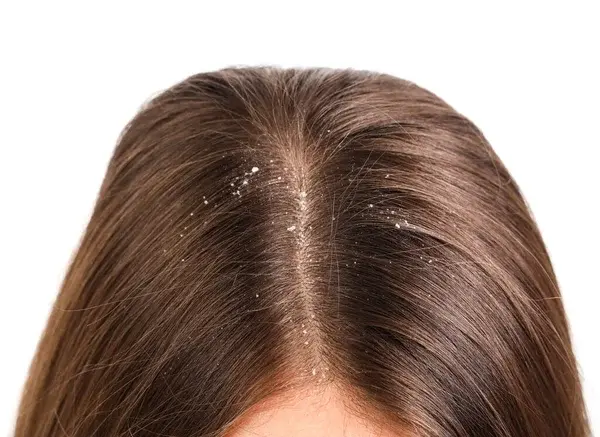 stock-photo-young-woman-dandruff-white-background-closeup.jfif