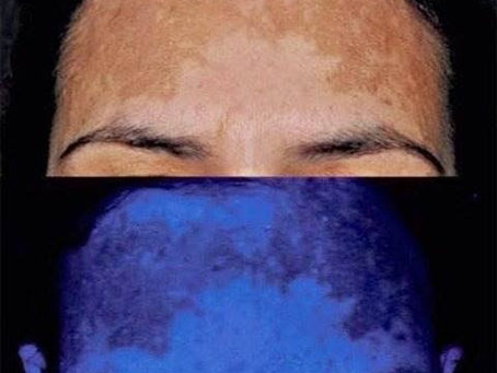 Ácido Tranêxamico e Melasma