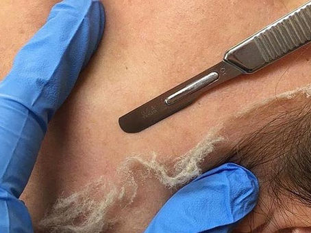 Dermaplaning: Softer, smoother, clearer skin in minutes!