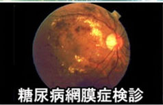 糖尿病網膜症検診