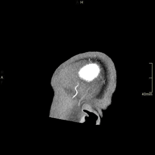 sagittal.gif