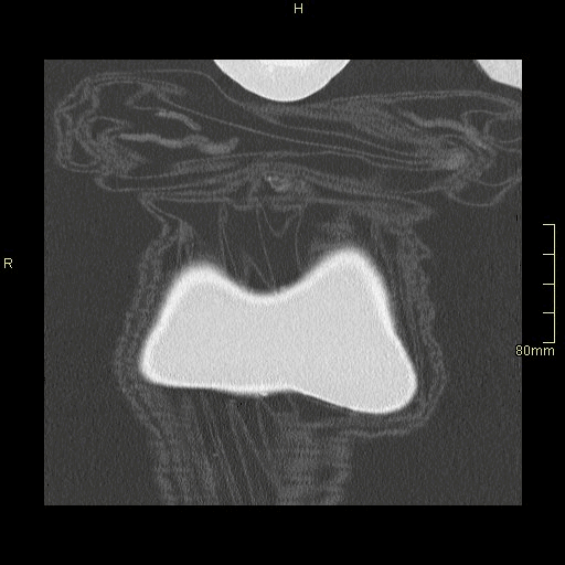 coronal lung supine exp.gif