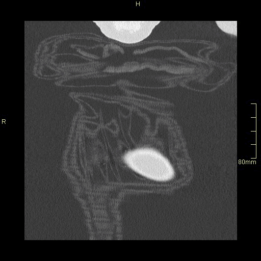 coronal lung supine insp.gif