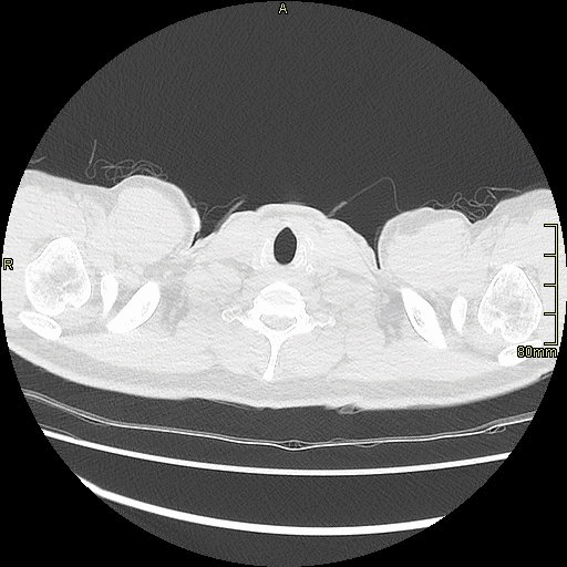 axial lung.gif