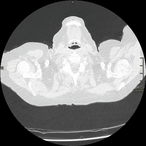 axial lung supine exp.gif