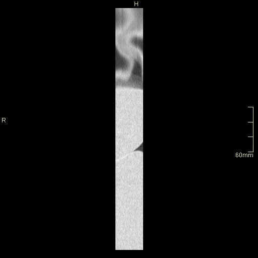 coronal lung prone insp.gif