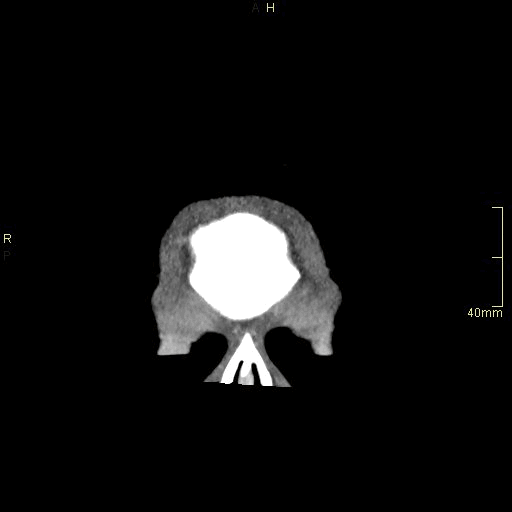 coronal.gif