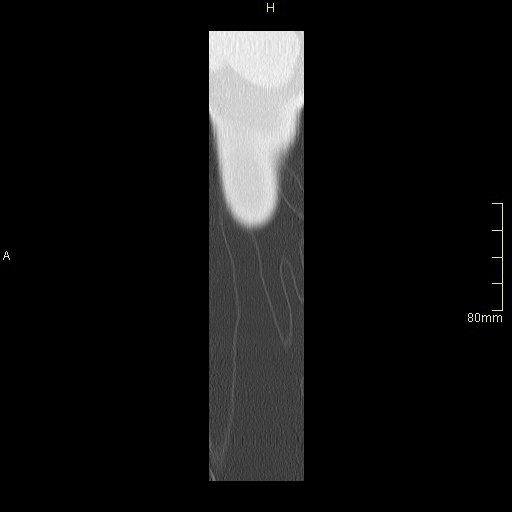 sagittal lung.gif