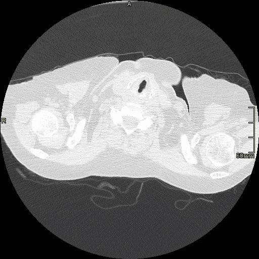 axial lung prone insp.gif