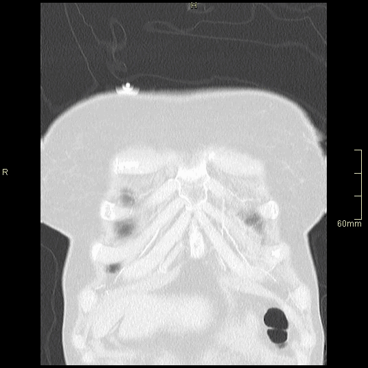 coronal lung.gif