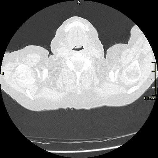 axial lung supine insp.gif