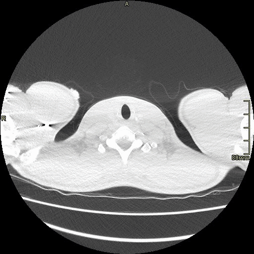 axial lung.gif