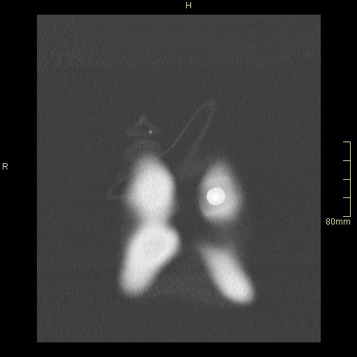 coronal lung.gif