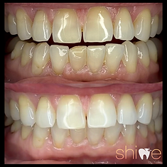 HOME LED WHITENING KITS AVAILABLE!.png