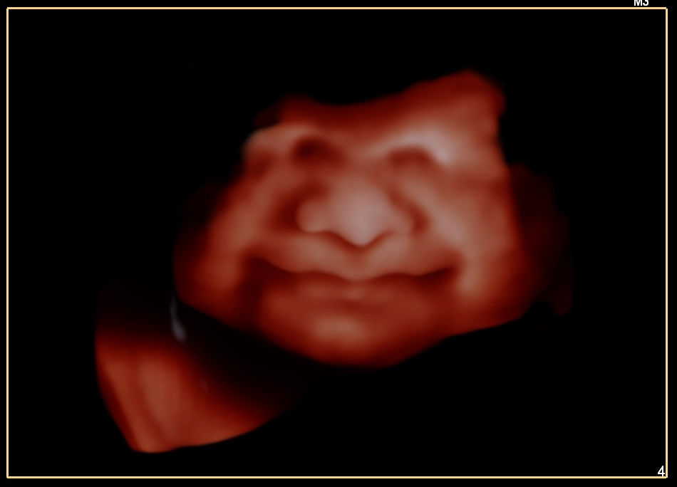 4D5D-37 weeks