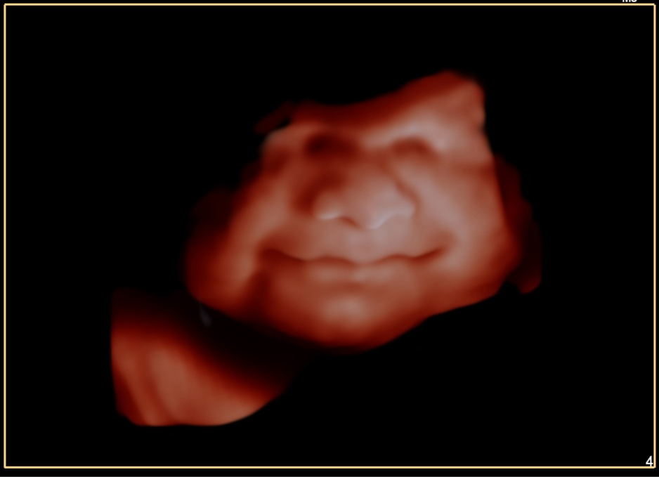 4D5D -37 weeks