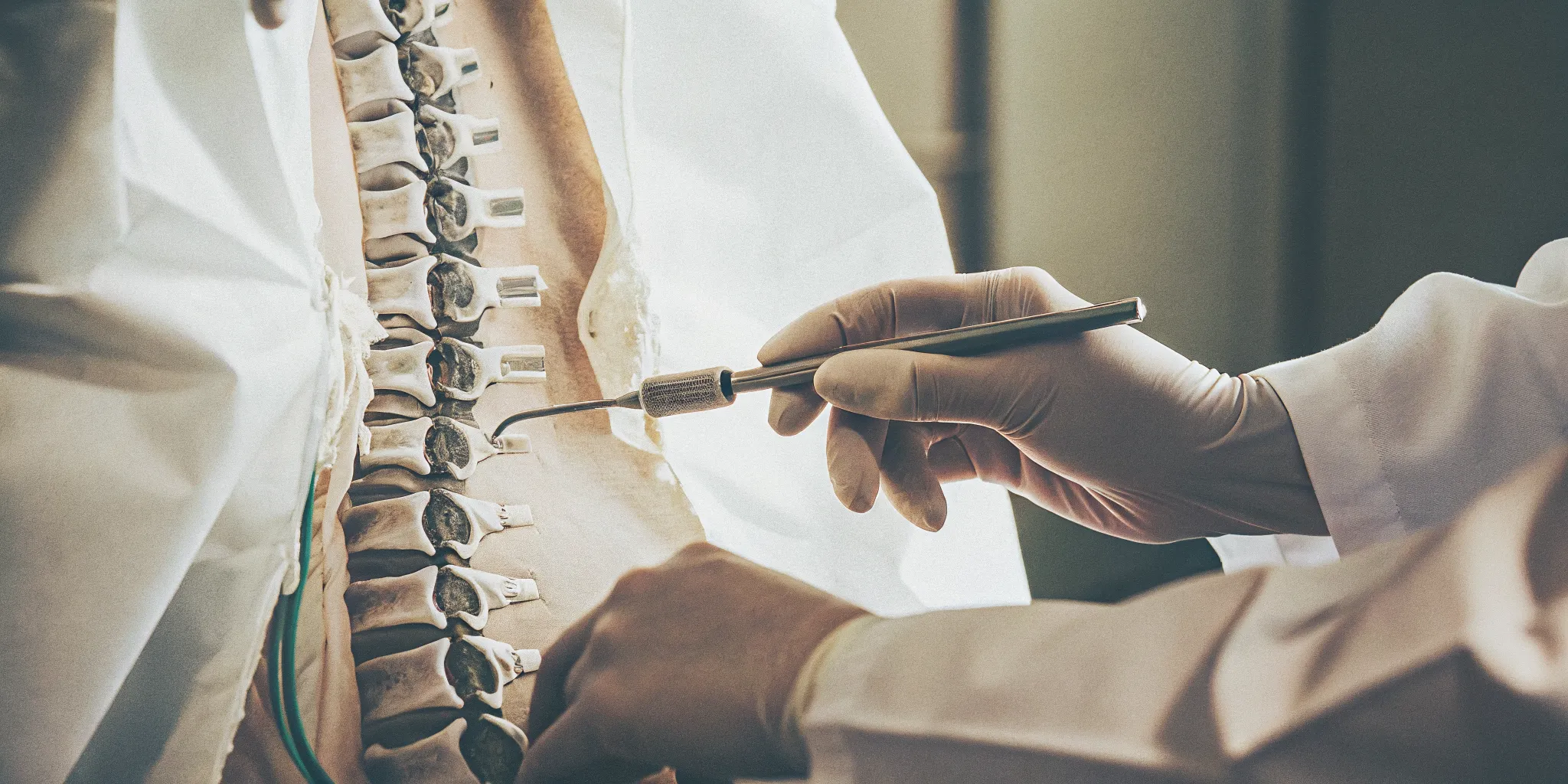 Minimally invasive Reactiv8 neurostimulation implant procedure for chronic low back pain