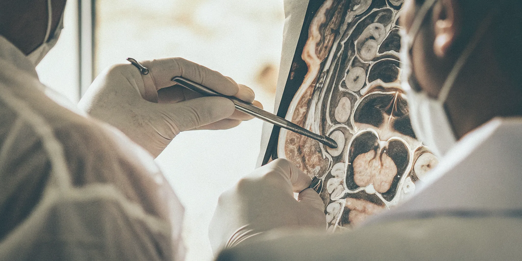 SPG block procedure being performed with precise technique for migraine pain management