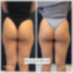 cellulite treatment before and after photo