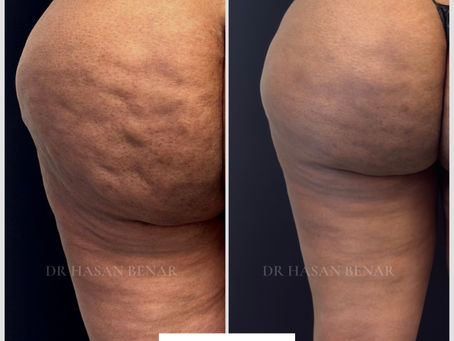Before and after CelluSmooth cellulite treatment, side view, by Dr Hasan Benar, London