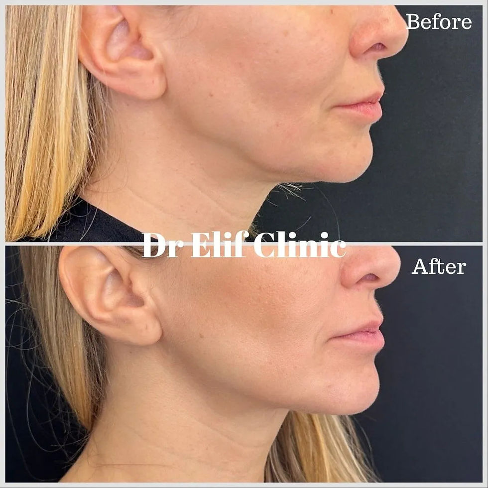endolift laser treatment