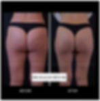 cellulite treatment before and after photo